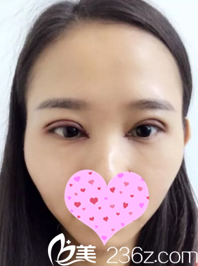 全切双眼皮多久能上班