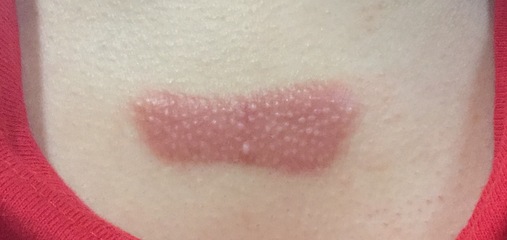 痘痘贴粘多久