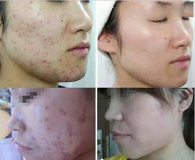 脸上有小的肤色痘痘