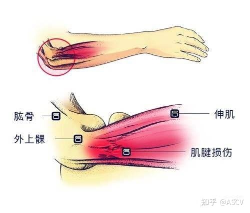 网球肘怎么治疗才能好