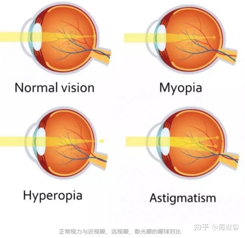 近视加散光可以做近视手术吗?近视加散光可以做近视手术吗?