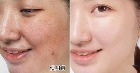 红血丝皮肤用什么面膜