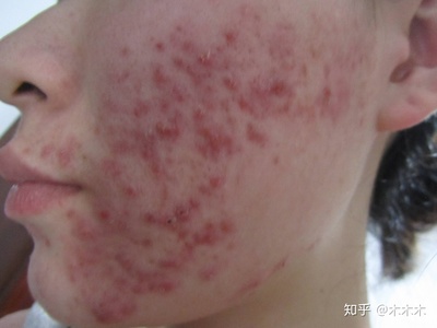 暗疮痘痘怎么治疗方法