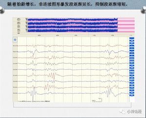新生儿做脑电图有影响吗