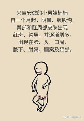 三个月宝宝有湿疹怎么办