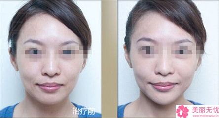 瘦脸针可以打四次吗