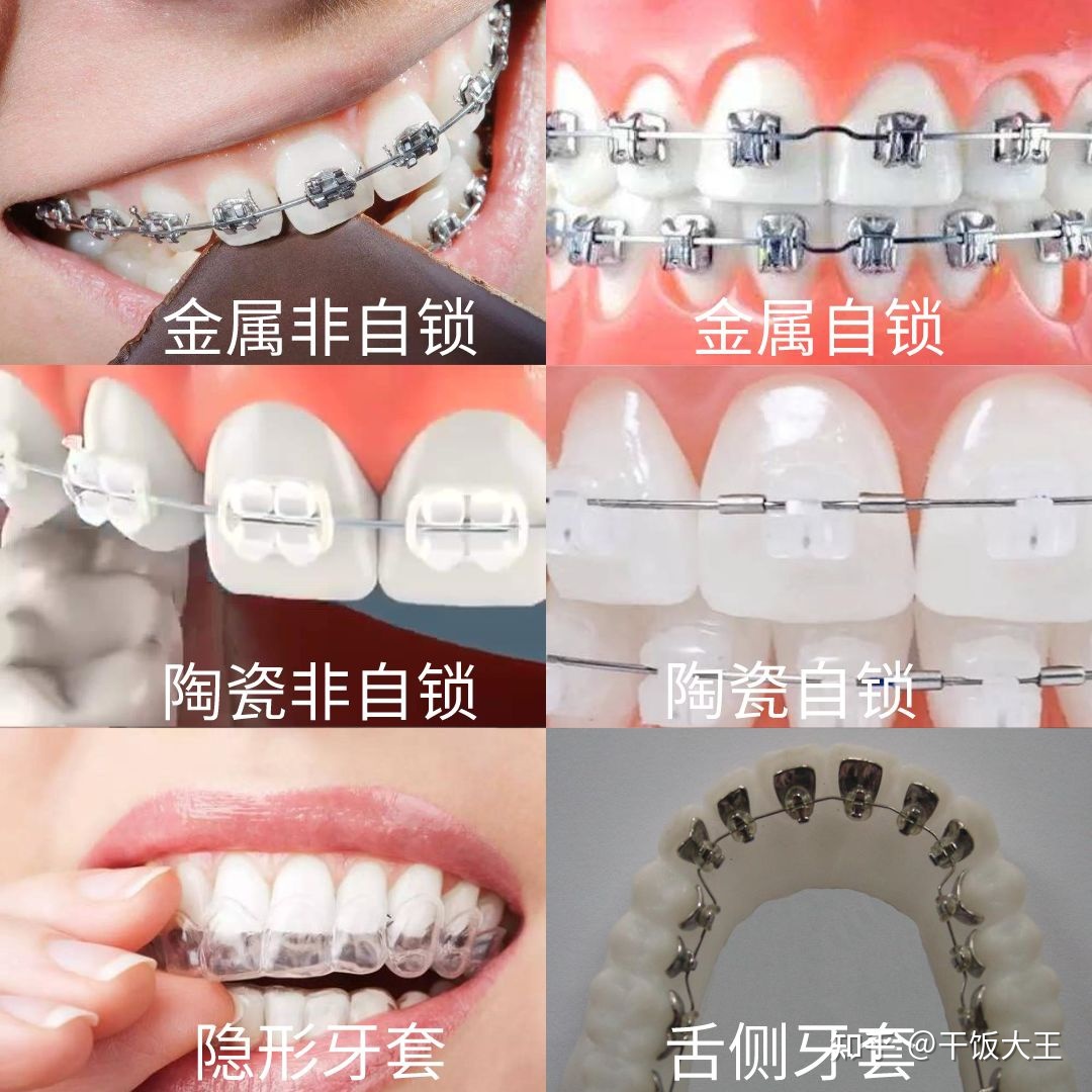 矫正牙齿隐形牙套价位