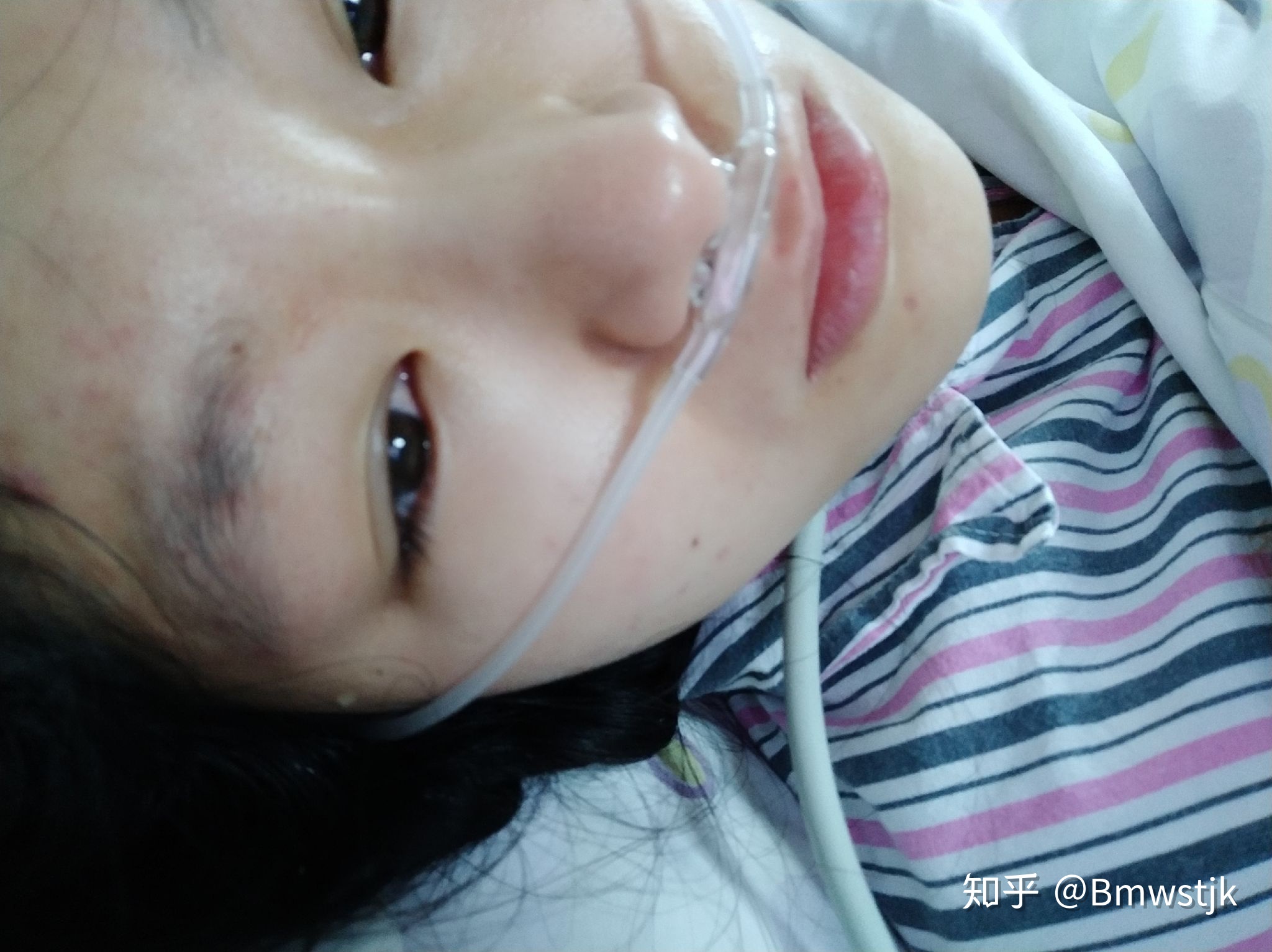 手术后发烧是怎么回事