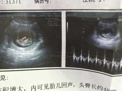 胎儿几个月会有胎动
