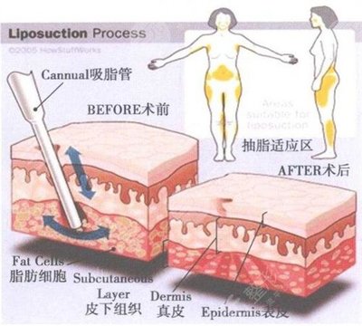 大腿抽脂的危害
