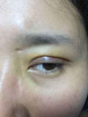 做完双眼皮来例假