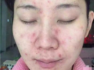 皮康王可以祛痘吗