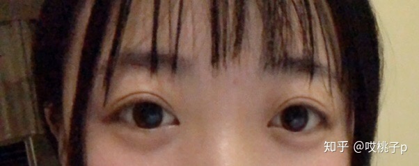 割双眼皮哭了怎么办