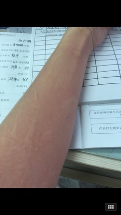 风疹是怎么回事