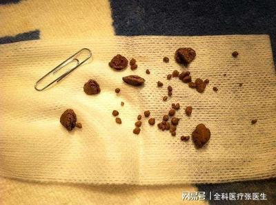结石怎么治疗效果好