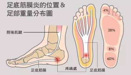 足底疼是怎么回事