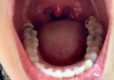 智齿牙龈发炎可以吃阿莫西林吗,狗牙龈发炎可以吃阿莫西林吗