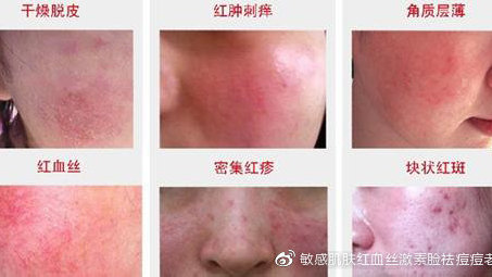 脸上用什么才能祛痘痘