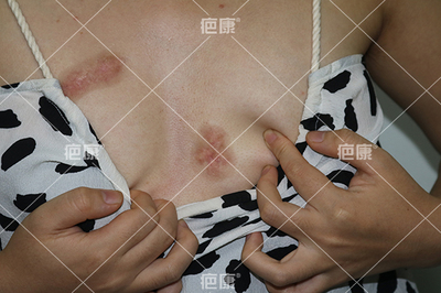 前胸长的痘痘会恢复吗
