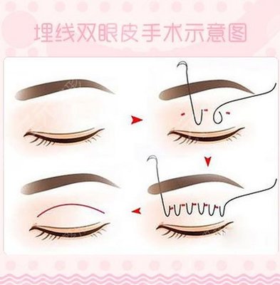 玻尿酸打泪沟几天消肿