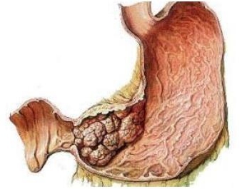 皮革胃怎么治疗