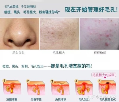 怎样去黑头痘痘