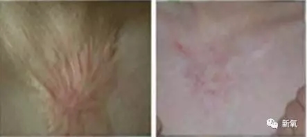 烫伤怎样不留疤痕