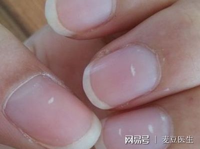 指甲上有黑纹是怎么回事