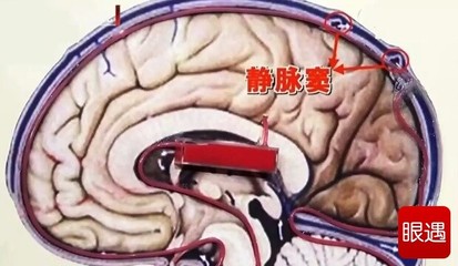 脑子有积液是怎么回事