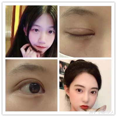沈阳 双眼皮