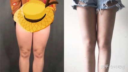 大腿抽脂三天后的照片
