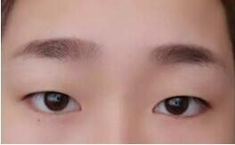 双眼皮为什么要开眼角