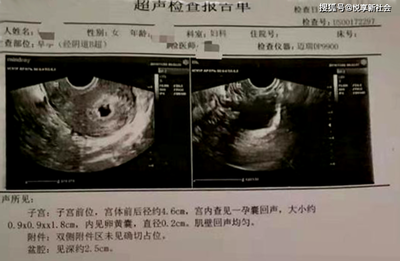 结扎三年了还会怀孕吗