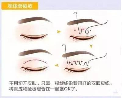 做双眼皮埋线好吗