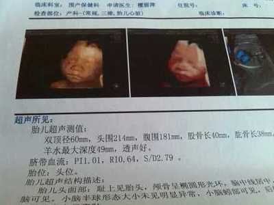 新生儿血小板偏低