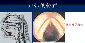 息肉子宫