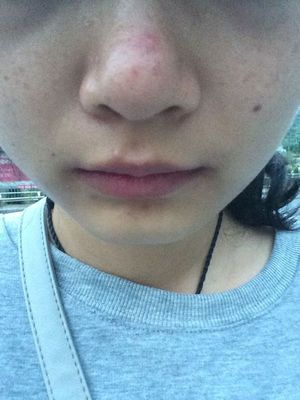 白色的大痘痘是什么原因