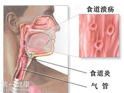 食道癌早期治疗自愈率有多少