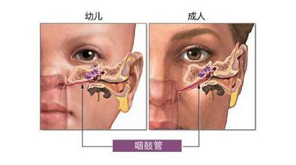 新生儿鼻腔狭窄