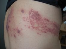 拜托带状疱疹可以运动吗,得了带状疱疹可以洗澡锻炼吗?