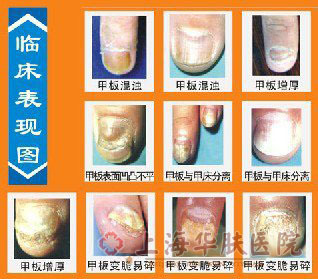 宝宝指甲根部皮肤发黑