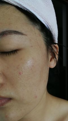 做痘痘一次激光多久恢复