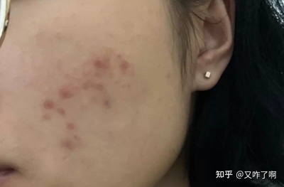 后青春期长痘痘怎么办