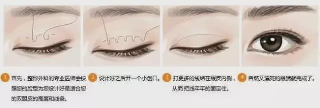 曲靖埋线双眼皮