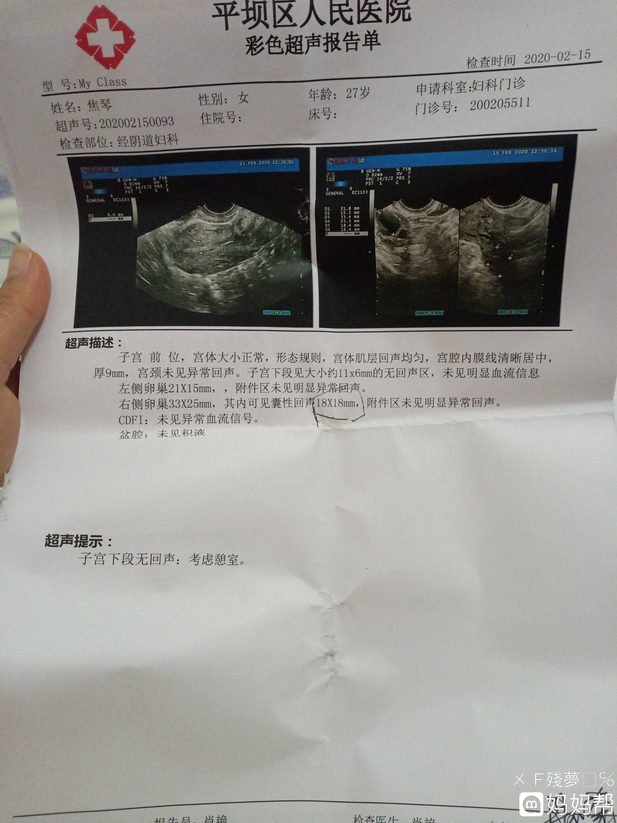 双侧卵巢多囊会怀孕吗