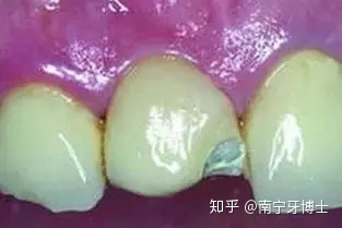烤瓷牙崩瓷怎么修复