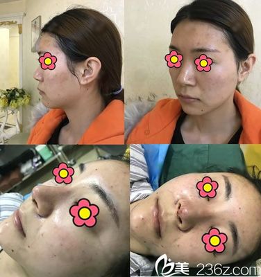 杭州医院隆鼻手术多少钱
