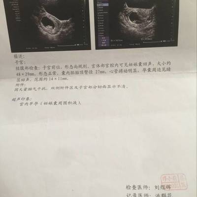 宫腔积液可以怀孕吗