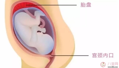 孕妇胎盘低是什么原因