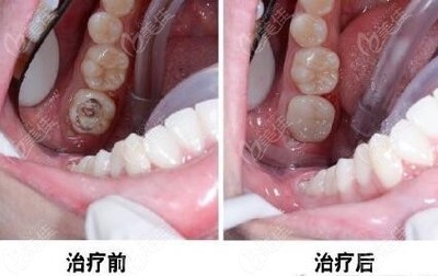 上海补牙多少钱